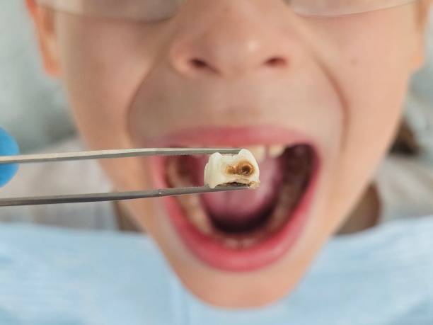 Best Emergency Tooth Extraction in East Richmond Heights, CA